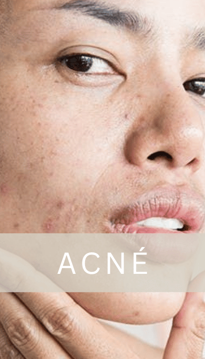 Tratamientos para acné por Dermagroup
