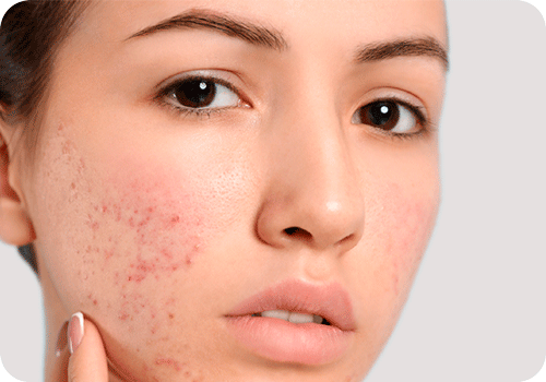 Dermocosmetica Problema de piel - ACNE