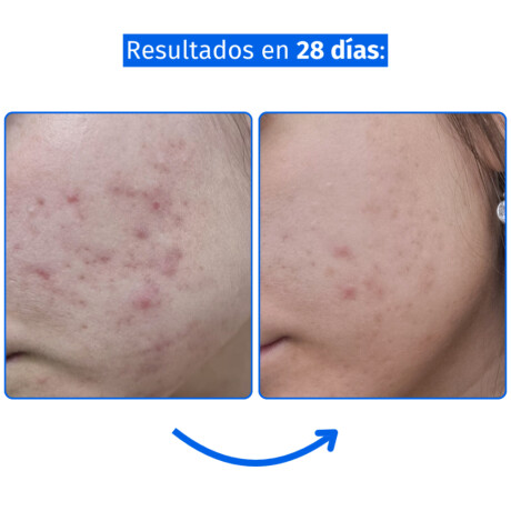 Sérum Facial Alma Exfoliante con Ácido Glicólico, Salicílico y PHA 30ml Sérum Facial Alma Exfoliante con Ácido Glicólico, Salicílico y PHA 30ml