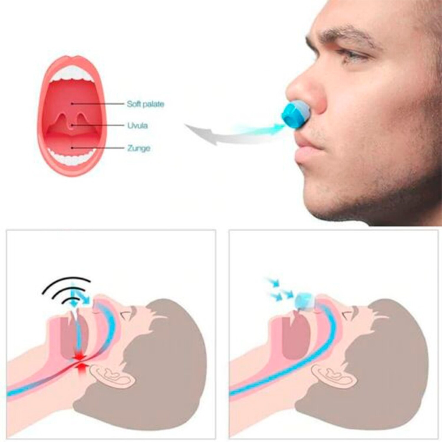 Anti Ronquidos Dilatador Nasal Aire Puro 2 En 1 Dormir - Variante