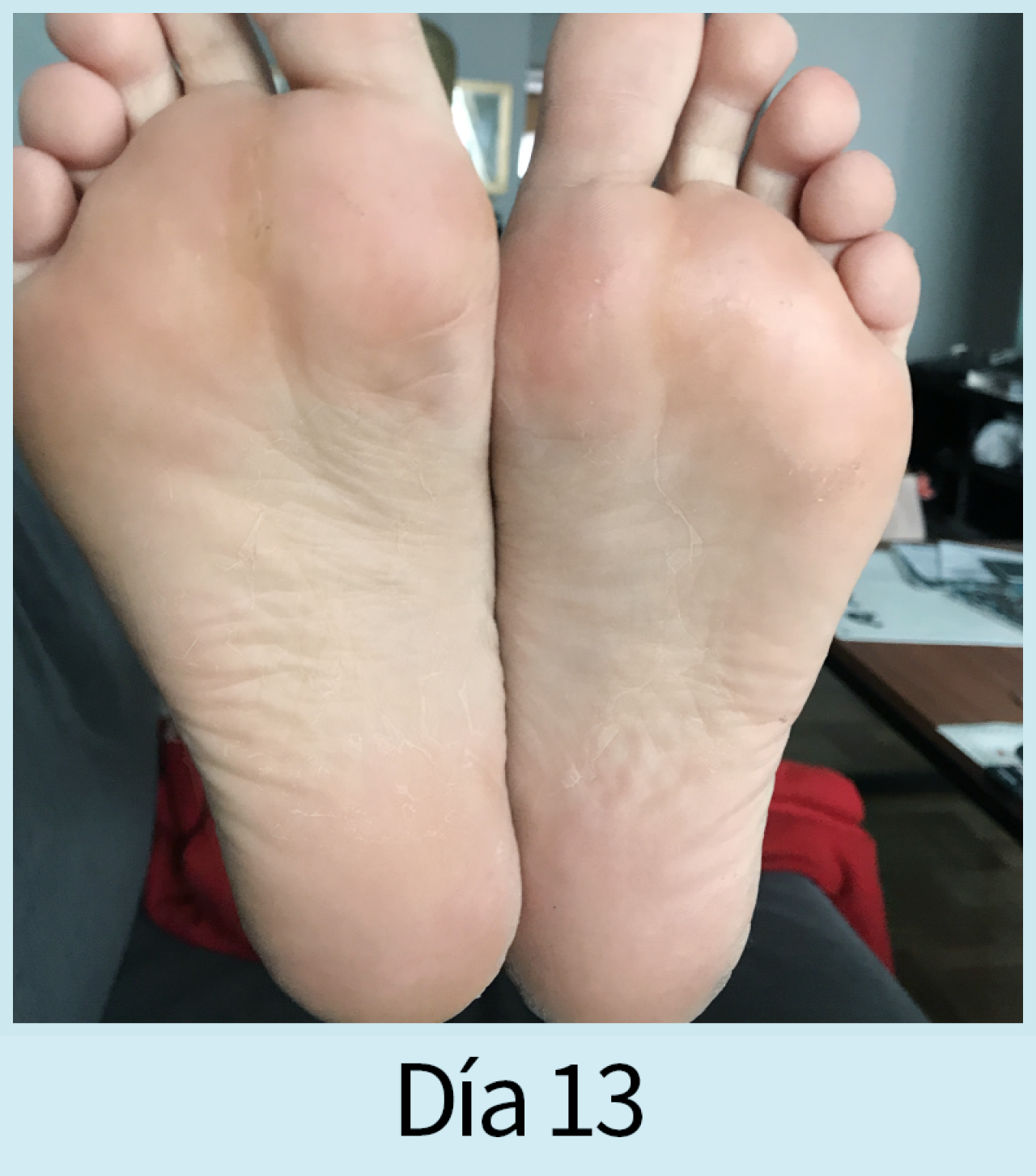 foot-peeling-13.png