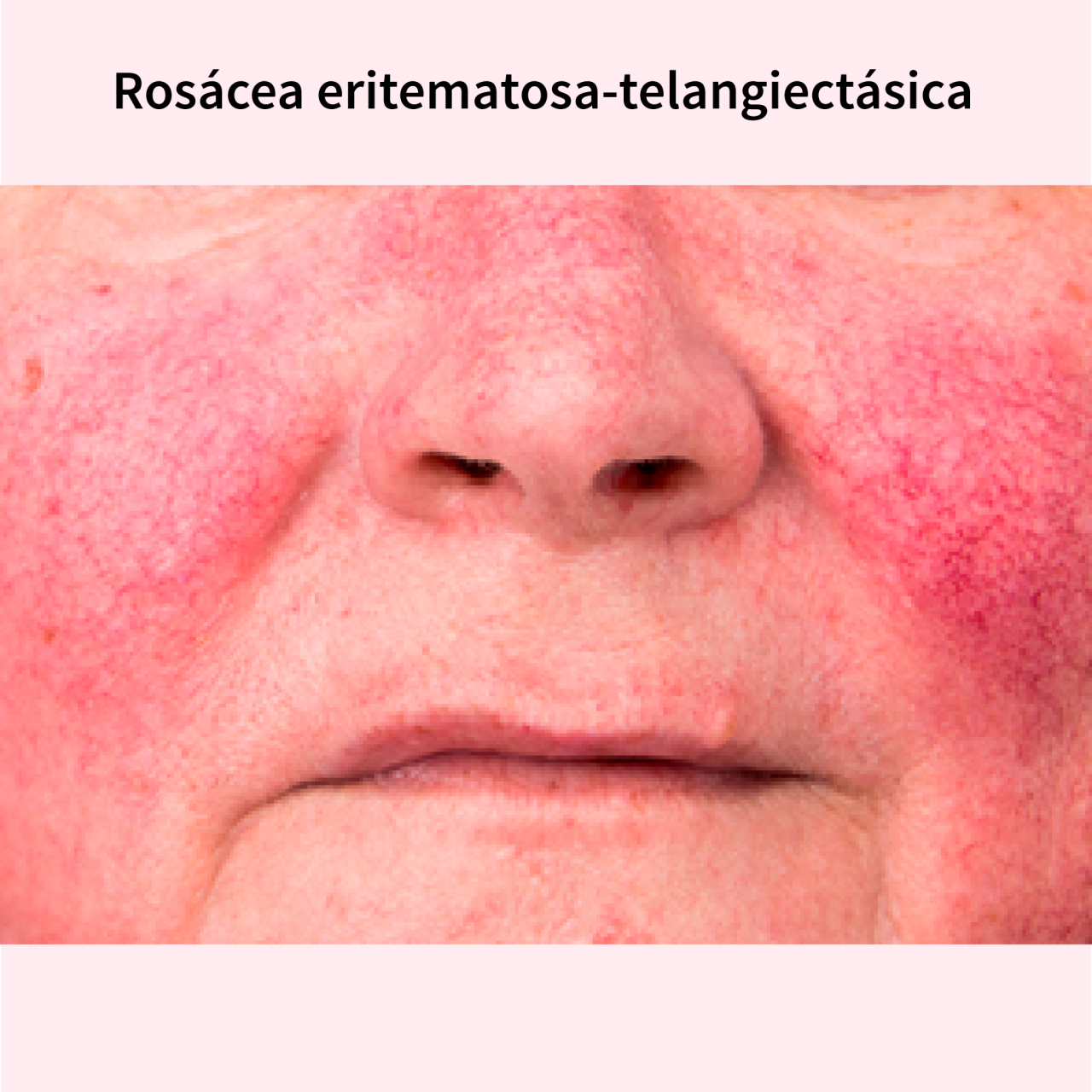 rosacea-eritematosa-telangiectas.png